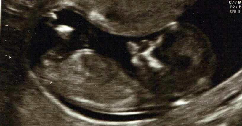 Seltsame, eklige und unerwartete Dinge, die Babys im Mutterleib tun